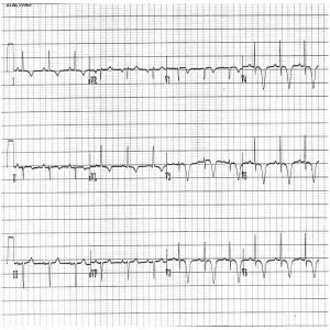 STEMI equiv 4 Wellens-Type-B